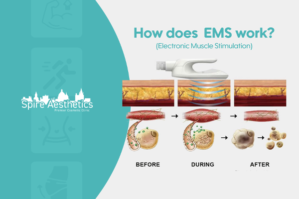 EMS treatment for post pregnancy weight loss treatment Trowbridge