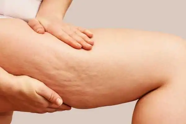 Image of woman showing leg with cellulite Trowbridge
