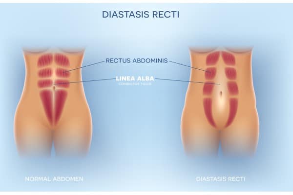 What Non-Surgical Options Are Available for Diastasis Recti Trowbridge?
