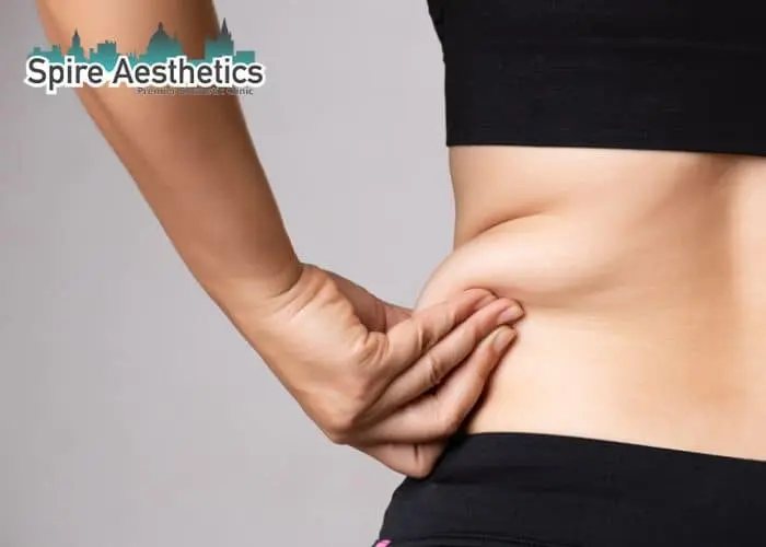 Image of woman pinching fat on their hips Trowbridge. Fat Freezing treatment