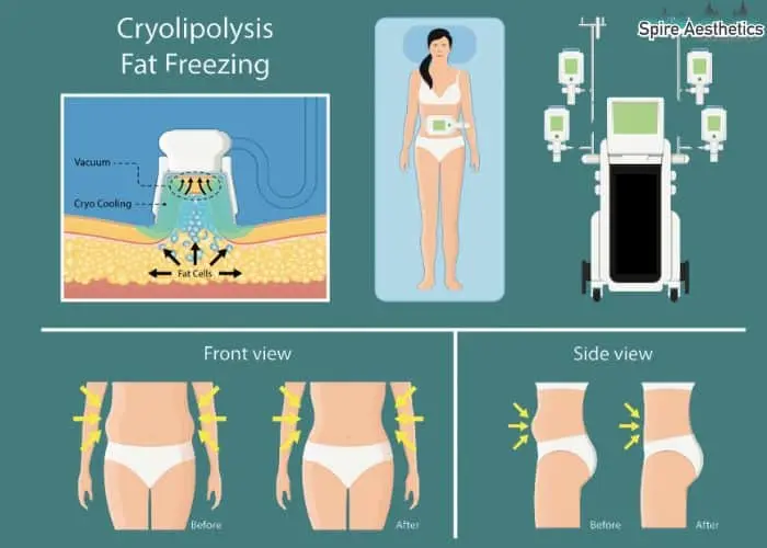 Fat freezing treatment Trowbridge benefits for competitions to remove stubborn fat deposits.