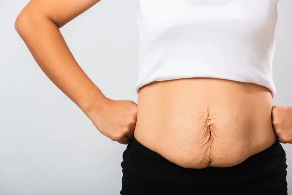 Image of a woman's stomach after weight loss with sagging skin following a gastric band Trowbridge