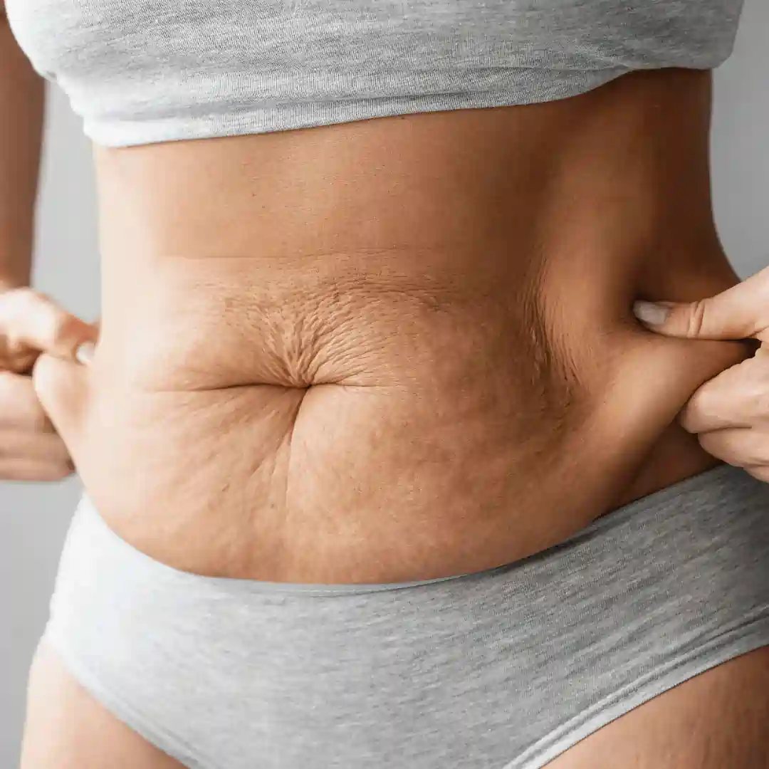 Is It Normal to Have Loose Skin After Pregnancy Trowbridge?