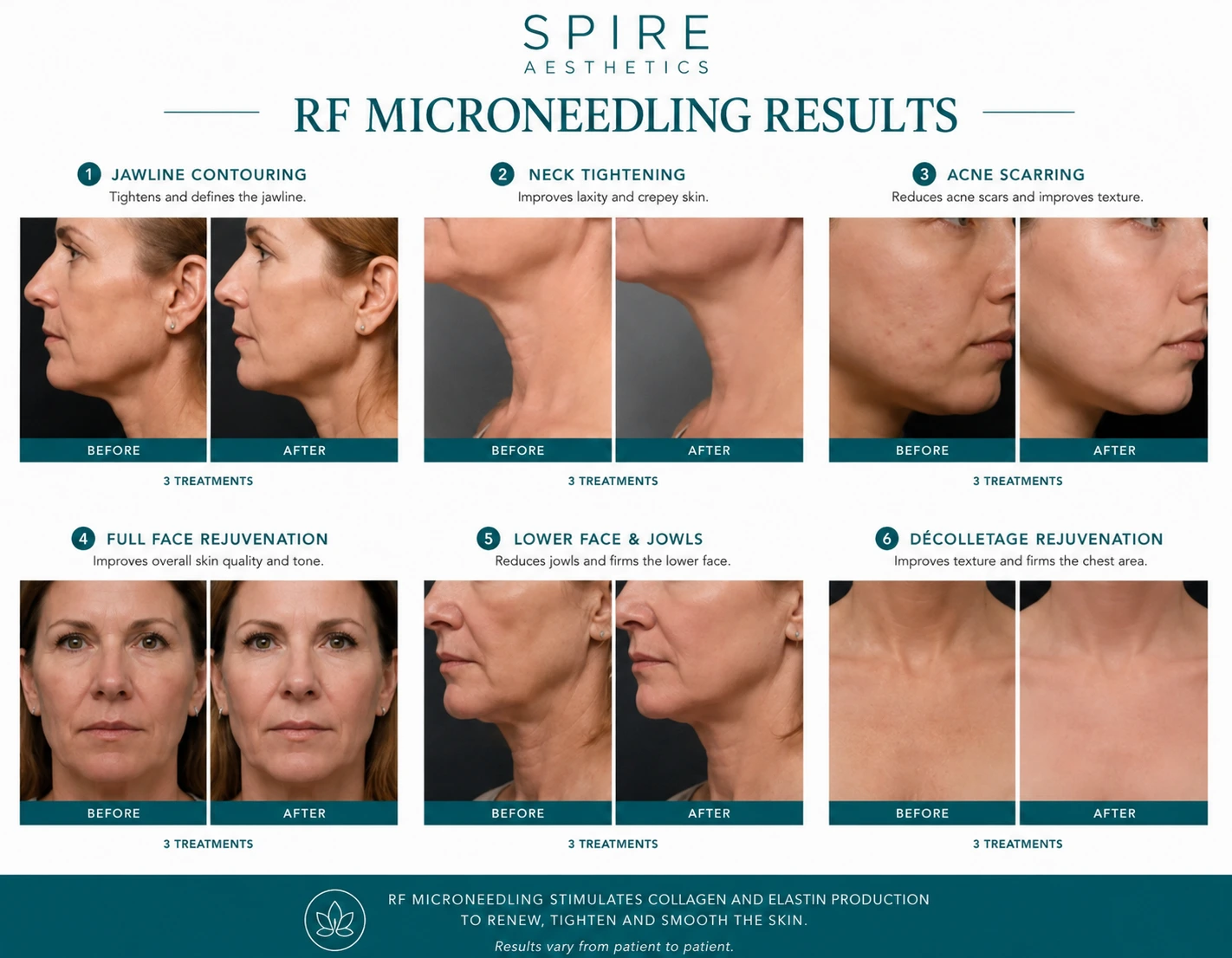 RF Microneedling Skin tightening Trowbridge results