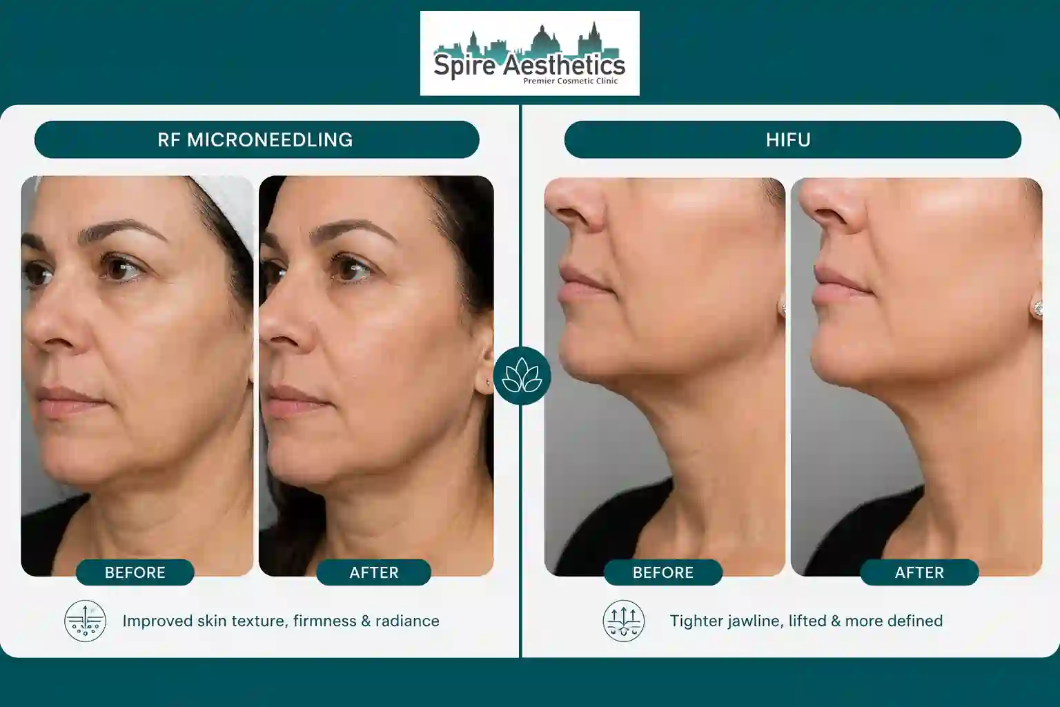 Can RF Microneedling and HIFU Be Combined Trowbridge?
