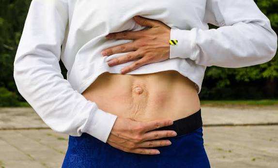 When Could Diastasis Recti Be the Missing Piece of the Puzzle Trowbridge?