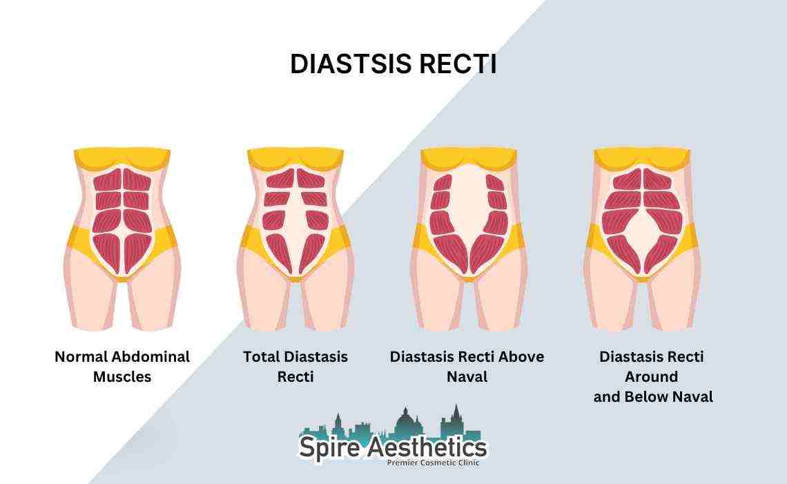 Is Non-Surgical Diastasis Recti Treatment Right for You? Common Concerns Answered Trowbridge